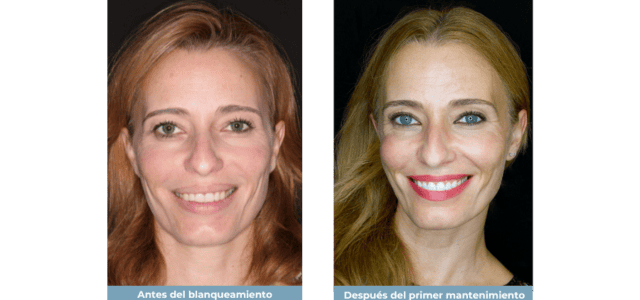 Resultado blanqueamiento dental