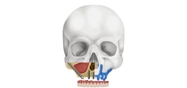 implantes-poco-hueso