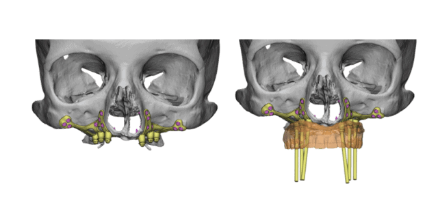 Implantes sin hueso