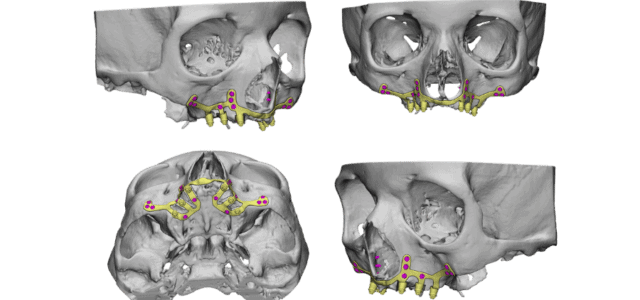 Malla implantes subperiosticos