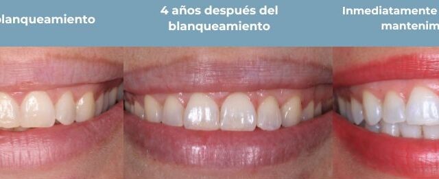 Sonrisa blanqueamiento dental