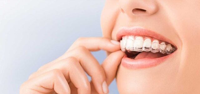 Tipos De Invisalign Y Ventajas De Casa Uno Ferrus Bratos