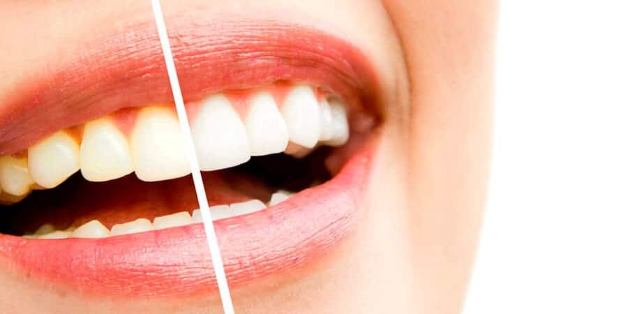 Blanquear los dientes con agua oxigenada ¿Es seguro?