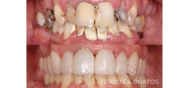 Antes y después de curetaje dental