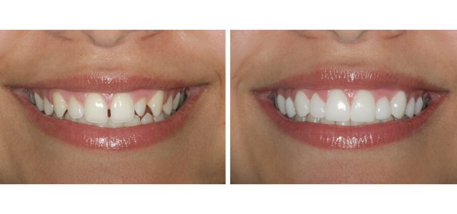 Qué son las carillas dentales y para qué sirven?