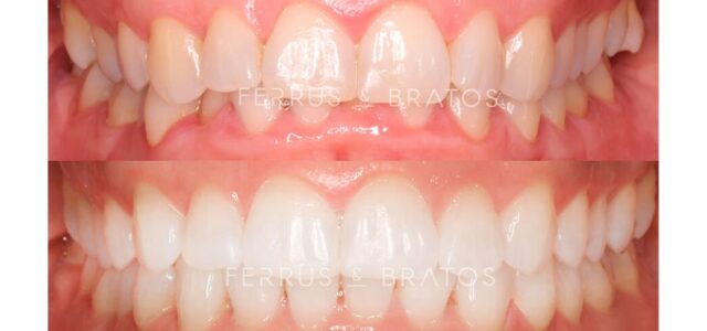 Antes y después de ortodoncia