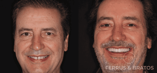 Rehabilitación sobre implantes dentales antes y después