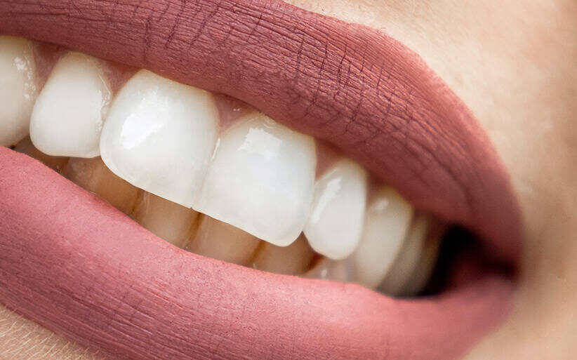 Qué son las carillas dentales? Ventajas y desventajas
