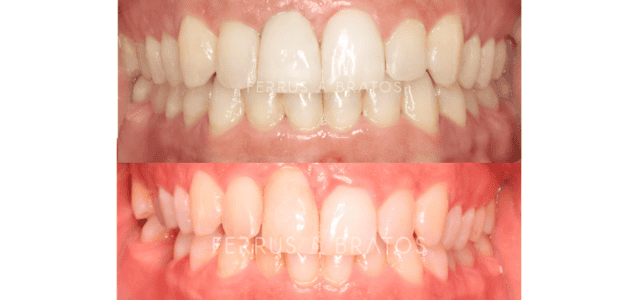 Cirugía mucogingival antes y después