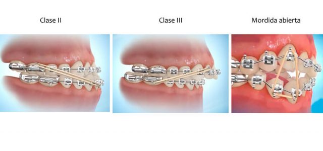 Gomas para brackets en ortodoncia, ¿qué son?