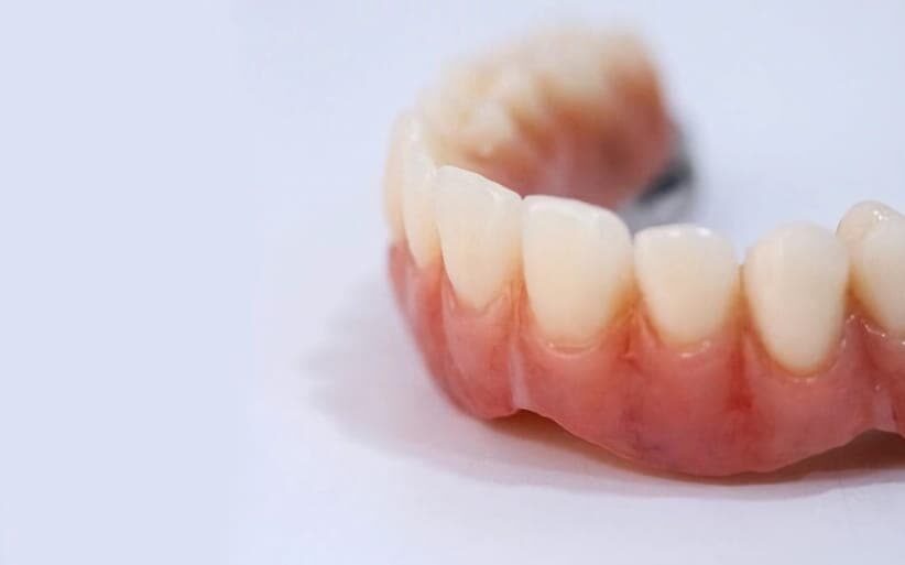 Prótesis dental fija: todos los tipos que existen