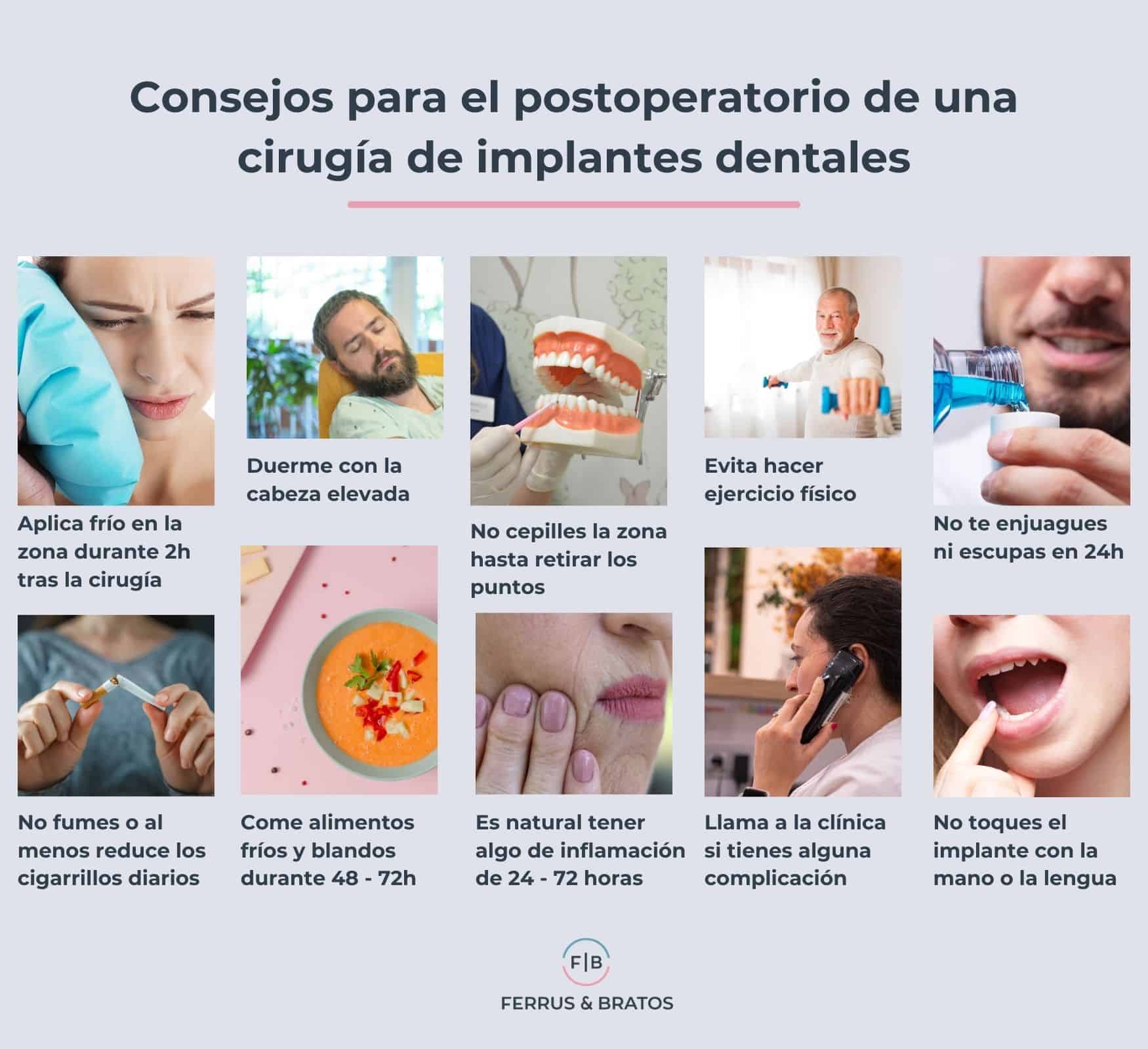 Consejos para los implantes dentales