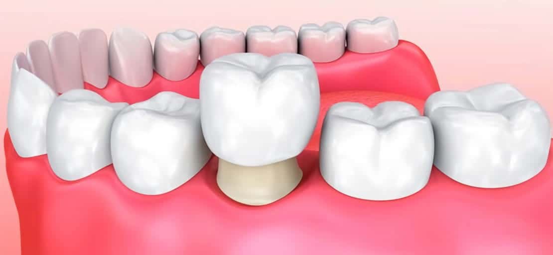 Coronas Dentales Molares de Metal, Corona Dental de Metal para Reducir la  Función de Masticación, Restauración de Pérdida de Dientes para Hospital :  : Salud y Cuidado Personal