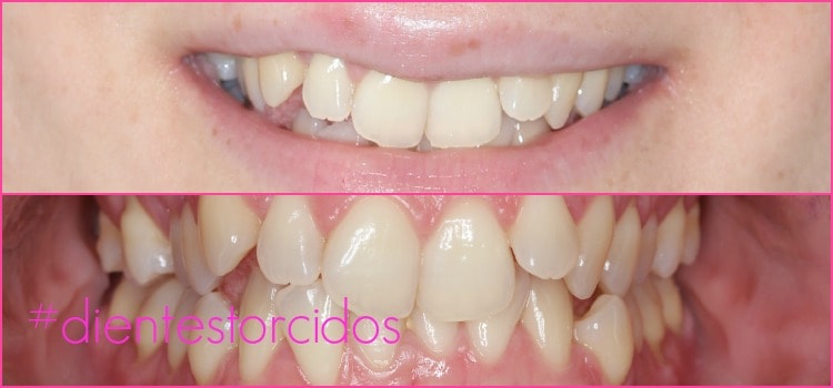 Dientes Torcidos | Ferrus&Bratos