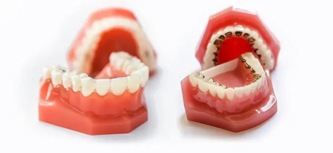 Ortodoncia Invisable Invisalign O Brackets Linguales Ferrus Bratos