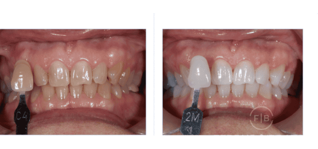 Antes y después de blanquear dientes