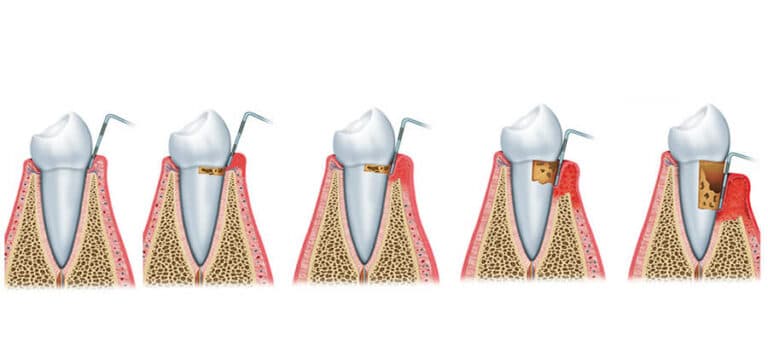 Periodontitis: Qué Es, Causas Y Tratamiento | Ferrus&Bratos