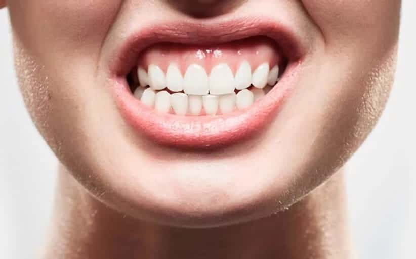 Férula de descarga para tratar bruxismo y TMD: todo lo que necesita saber -  Clínica Dental Rocamora