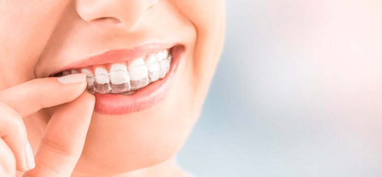 Invisalign La Ortodoncia Invisible Sin Brackets Ferrus Bratos