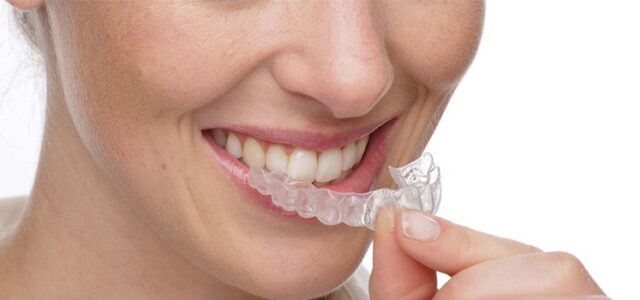 Invisalign Las 6 Razones Por Las Que Lo Elegiras