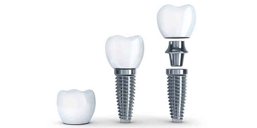 Prótesis Dental Fija: Todos Los Tipos Que Existen | Ferrus&Bratos