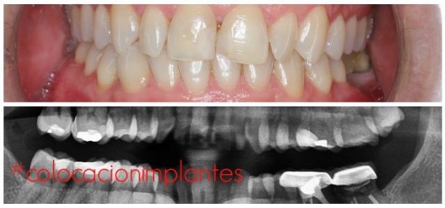 ¿Cómo Se Colocan Los Implantes Dentales? - Ferrus & Bratos