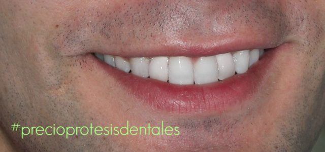 ¿Cuánto Cuesta Prótesis Dental? | Ferrus&Bratos