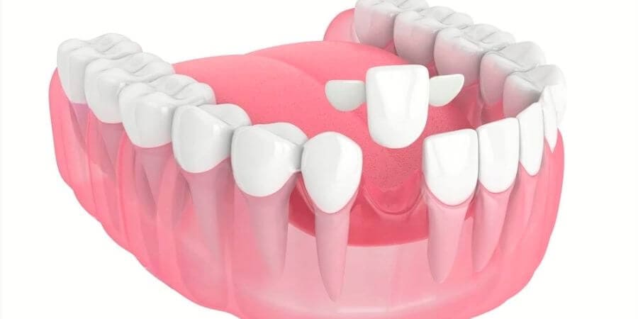 Puentes Dentales: Tipos Y Características | Ferrus&Bratos