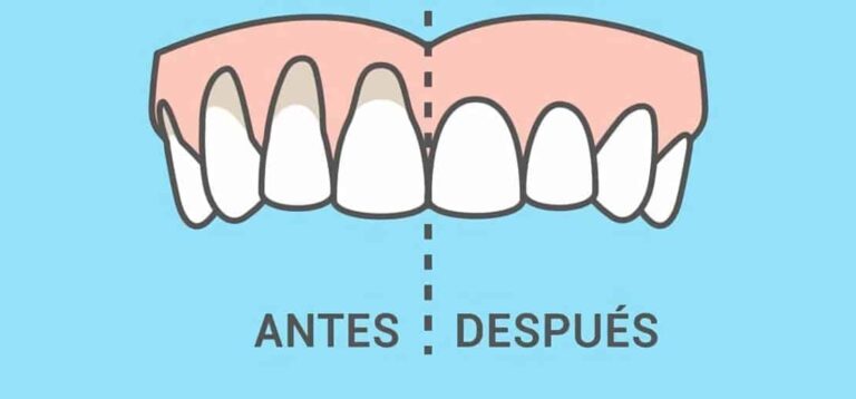 Encías Retraídas: Descubre Sus Causas Y Soluciones | Ferrus&Bratos