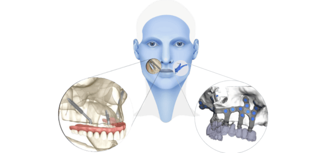 Implantes-subperiosticos