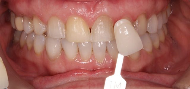 Qué son las carillas dentales? ¿En qué consiste el tratamiento?