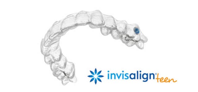 Invisalign adolestru