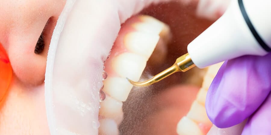 ¿qué Es Un Ultrasónico Dental O Scaler Usos En Odontologíaemk 3294