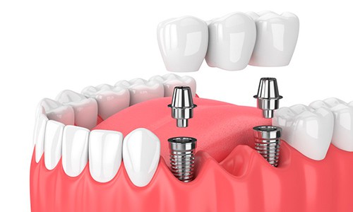 amplitud Disturbio cayó Los puentes dentales cuestan menos que los implantes? | Ferrus&Bratos